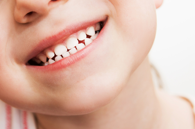 Cavities in Kids: What to do to prevent tooth decay?