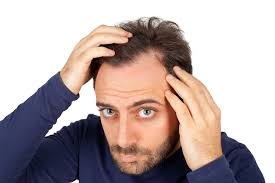 Receding Hairline: Causes, Symptoms and Treatments