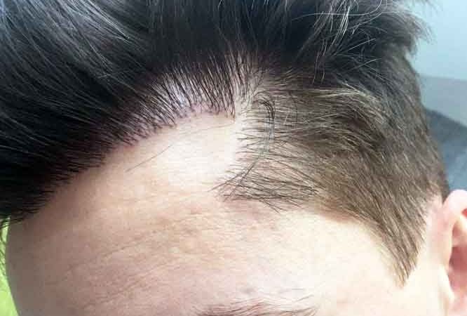 Hair Transplant In The UK: How To Get The Best Results