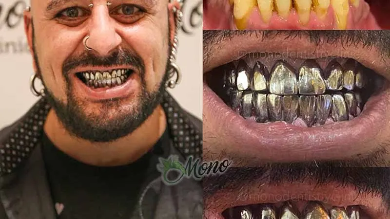 Best Price of Dental Implant Turkey